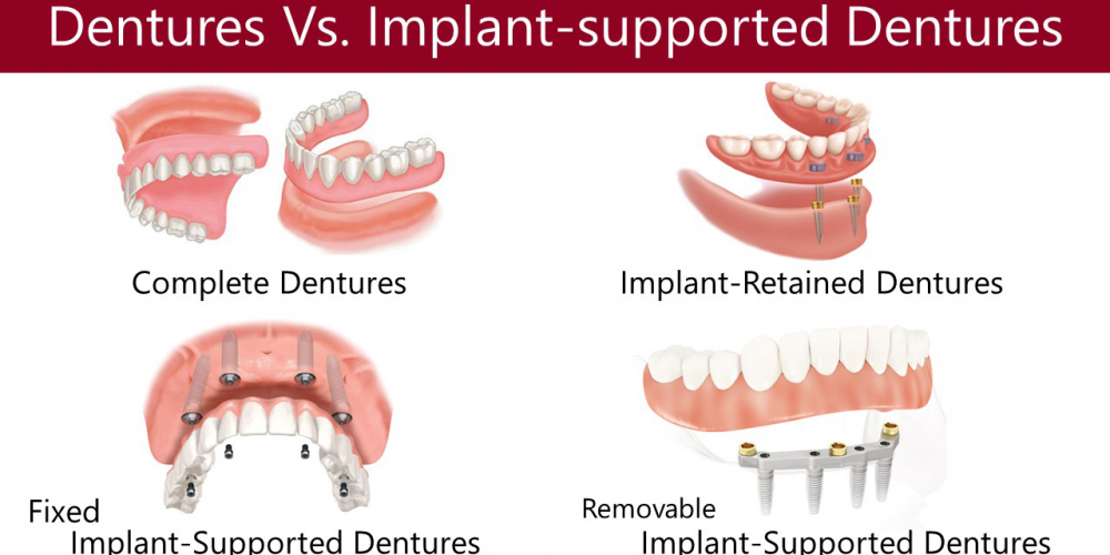 Temporary Dentures vs. Permanent Dentures - Pickett Family Dental