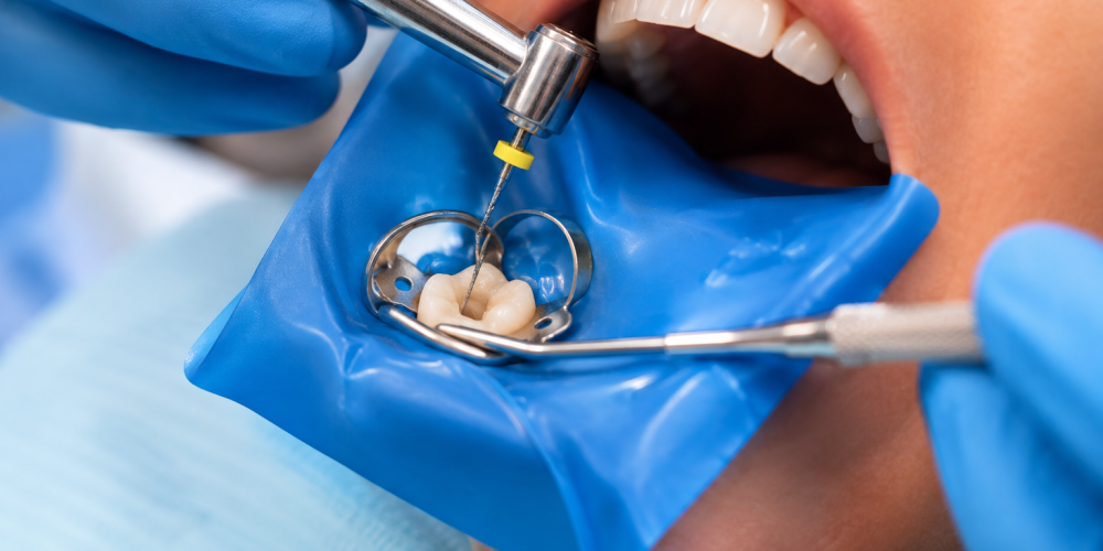 Dentist performing root canal treatment on a patient in a modern dental clinic.